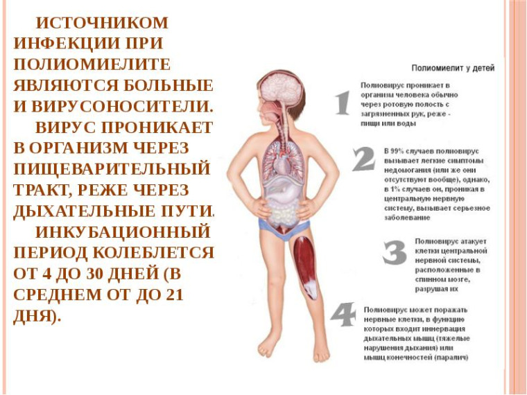 Полиомиелит.